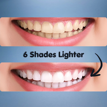 Professional LED Teeth Whitening Kit
