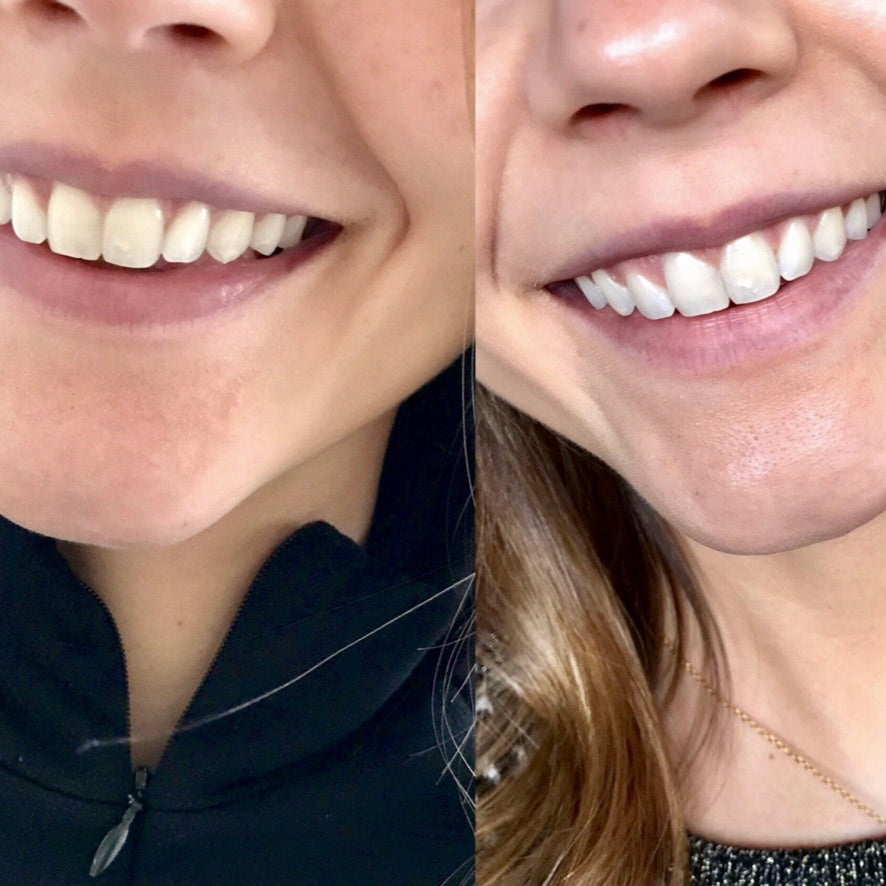 files/Oral-Essentials-Whitening-Strips-Before-and-After.jpg